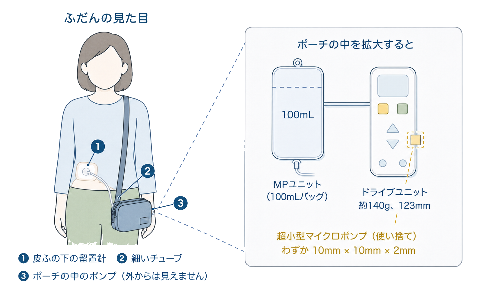 持続皮下注射のしくみ：皮ふの下の細い針からチューブでつながる小さなポンプは、超小型マイクロポンプを本体に装着して使います